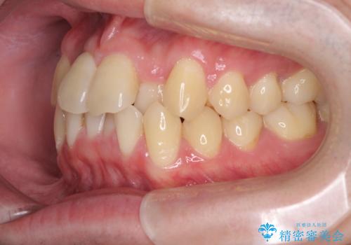 前歯のクロスバイト インビザラインによる矯正治療の治療前