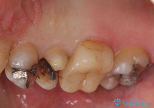 銀歯の下が虫歯　セラミックインレーにの治療中