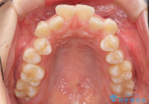 八重歯の治療 仕上がり重視での治療前