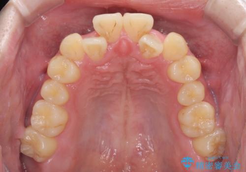 前歯のクロスバイト インビザラインによる矯正治療の治療前