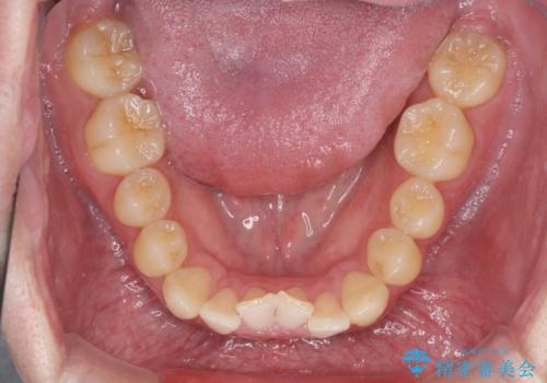 前歯のクロスバイト インビザラインによる矯正治療の治療前