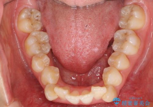 八重歯の治療 仕上がり重視での治療前