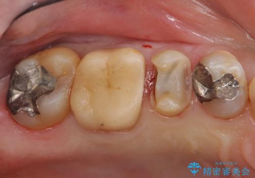 銀歯の下が虫歯 セラミックインレーにの治療中