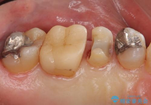 銀歯の下が虫歯 セラミックインレーにの治療中