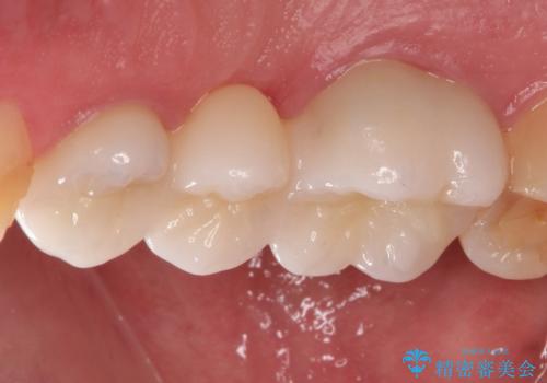 根管治療からのオールセラミックブリッジ装着の治療後