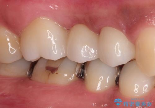 根管治療からのオールセラミックブリッジ装着の治療後