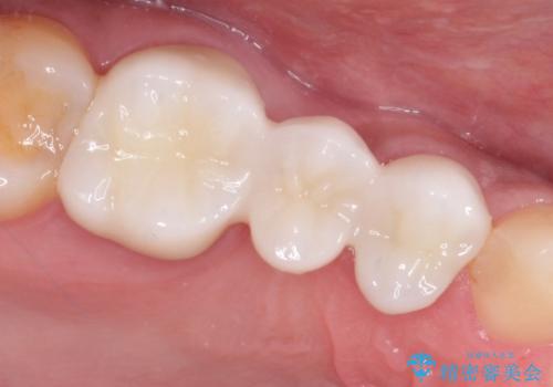 根管治療からのオールセラミックブリッジ装着の治療後