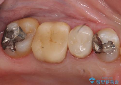 銀歯の下が虫歯　セラミックインレーにの症例 治療後
