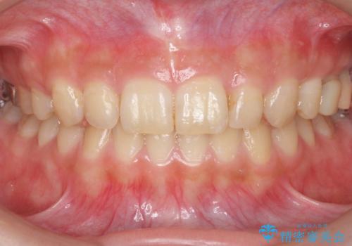 前歯のがたつき　過蓋咬合の症例 治療後