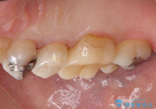 銀歯の下が虫歯　セラミックインレーにの治療後