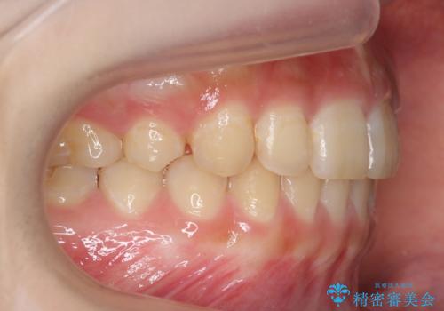前歯のがたつき　過蓋咬合の治療後