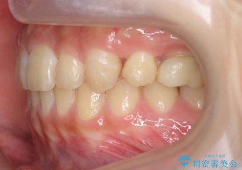 前歯のがたつき 過蓋咬合の治療後