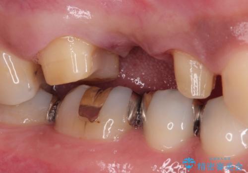 根管治療からのオールセラミックブリッジ装着の治療中