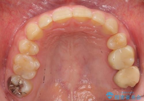 前歯のがたつき 過蓋咬合の治療後