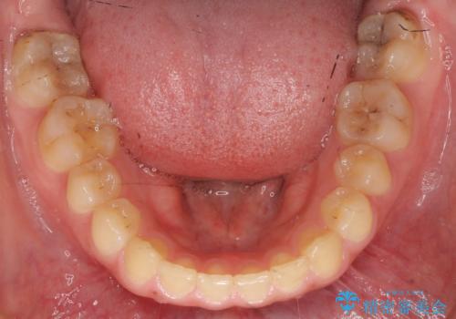 前歯のがたつき　過蓋咬合の治療後