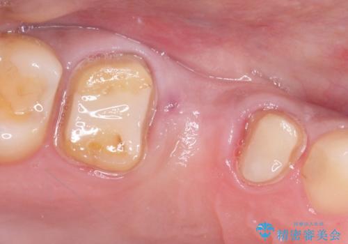 根管治療からのオールセラミックブリッジ装着の治療中