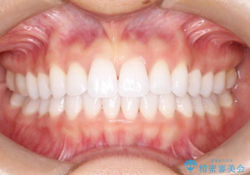 気になる前歯の歯並びをインビザラインで矯正の症例 治療後