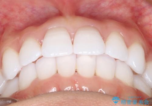 気になる前歯の歯並びをインビザラインで矯正の治療後