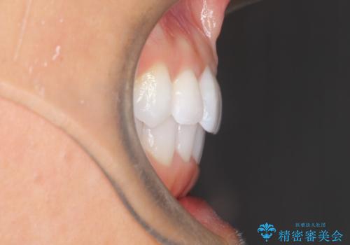 気になる前歯の歯並びをインビザラインで矯正の治療後