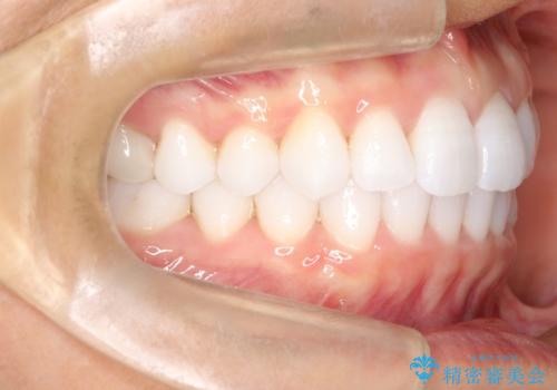 気になる前歯の歯並びをインビザラインで矯正の治療後