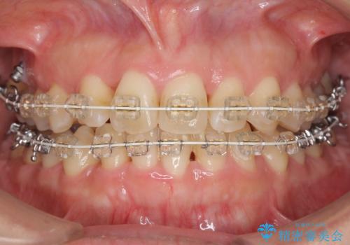 30代女性　残った乳歯を抜いてスペースを閉じる矯正　前歯のねじれの治療中