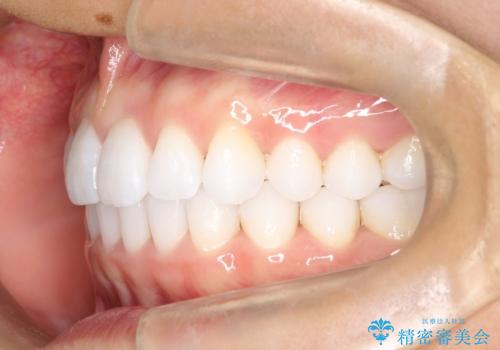 気になる前歯の歯並びをインビザラインで矯正の治療後