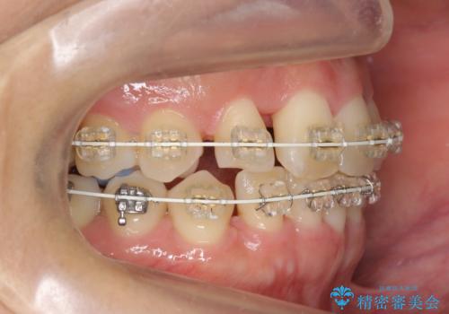 30代女性 残った乳歯を抜いてスペースを閉じる矯正 前歯のねじれの治療中