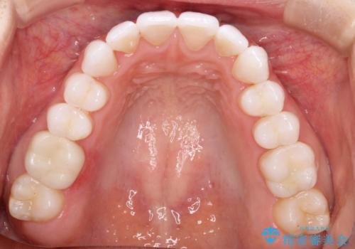 気になる前歯の歯並びをインビザラインで矯正の治療後