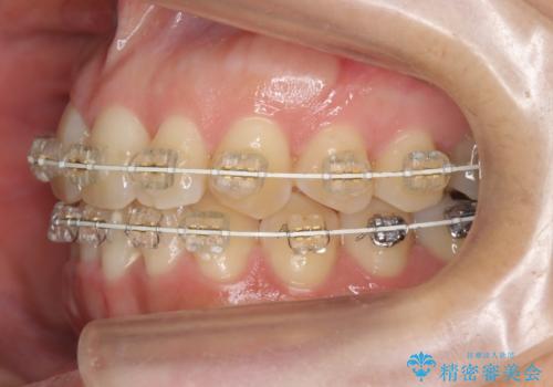 30代女性 残った乳歯を抜いてスペースを閉じる矯正 前歯のねじれの治療中