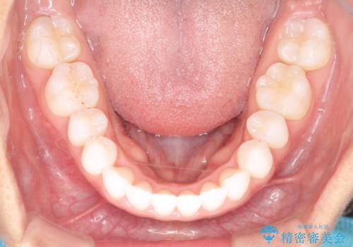 気になる前歯の歯並びをインビザラインで矯正の治療後