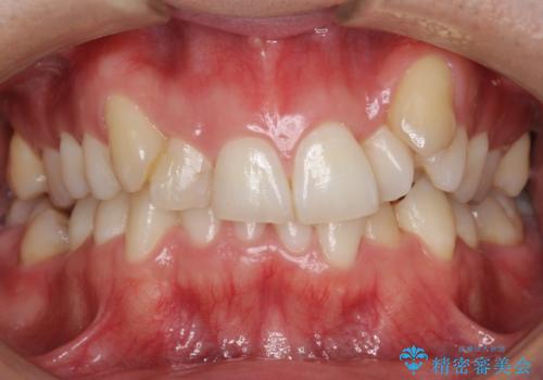八重歯の矯正+歯のないところにインプラントの症例 治療前