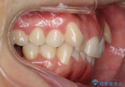 八重歯の矯正+歯のないところにインプラントの治療前