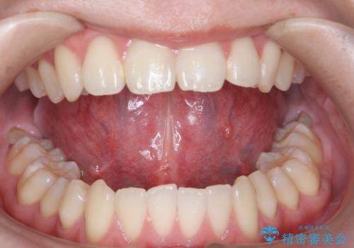 成人の舌小帯切除　舌が動かしにくいの治療後