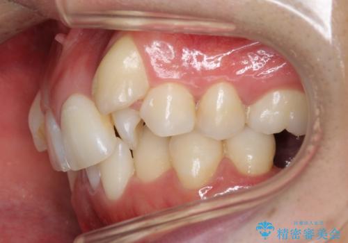 八重歯の矯正+歯のないところにインプラント