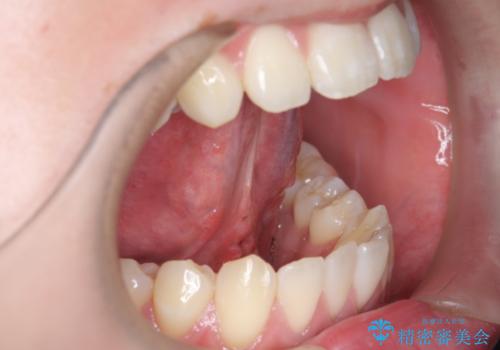 成人の舌小帯切除　舌が動かしにくいの治療後