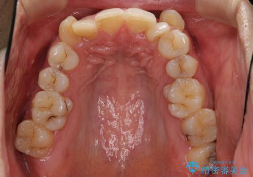 八重歯の矯正+歯のないところにインプラントの治療前