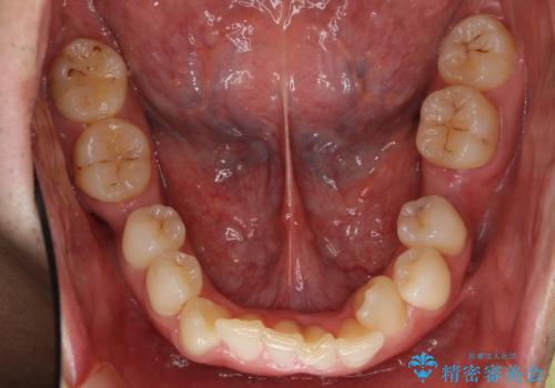 八重歯の矯正+歯のないところにインプラントの治療前