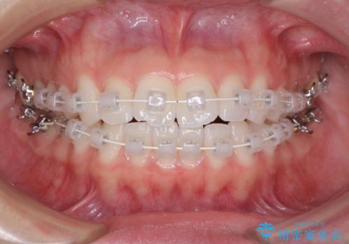 留学前に矯正治療 目立たないワイヤー装置でのスピード矯正の治療中