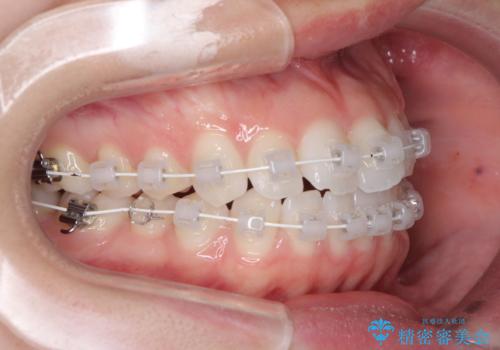 留学前に矯正治療 目立たないワイヤー装置でのスピード矯正の治療中