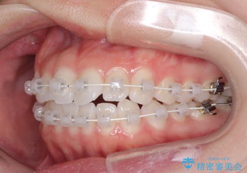 留学前に矯正治療 目立たないワイヤー装置でのスピード矯正の治療中