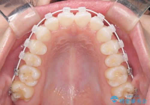 留学前に矯正治療 目立たないワイヤー装置でのスピード矯正の治療中
