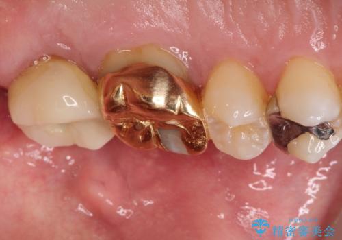 目立つ金歯を自然な色のオールセラミックへの治療前