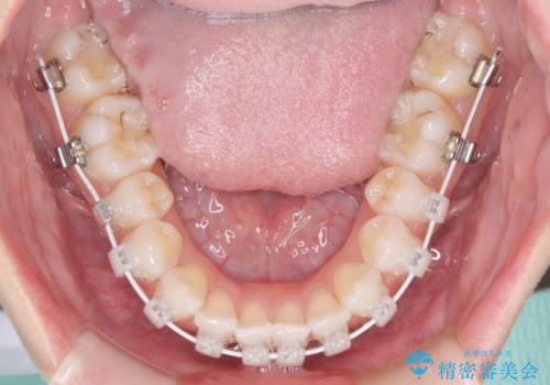 留学前に矯正治療 目立たないワイヤー装置でのスピード矯正の治療中