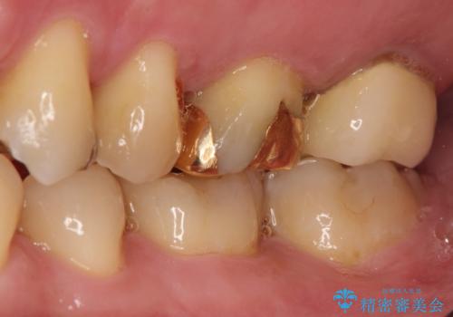 目立つ金歯を自然な色のオールセラミックへの治療前