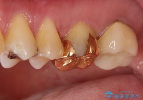 目立つ金歯を自然な色のオールセラミックへの治療前
