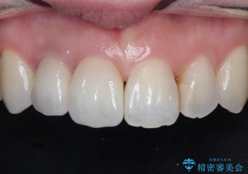 前歯が痛い。根管治療~オールセラミッククラウン