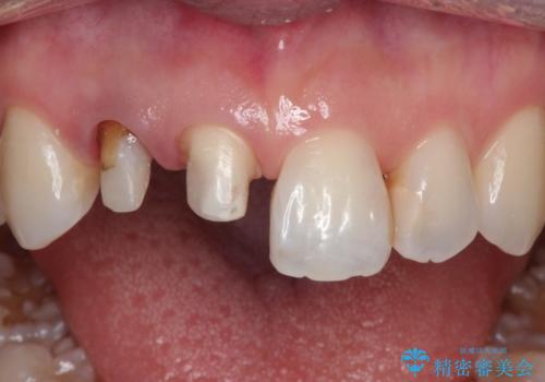 前歯が痛い。根管治療~オールセラミッククラウンの治療中