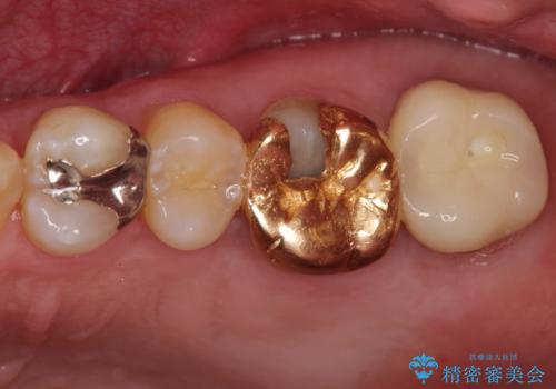 目立つ金歯を自然な色のオールセラミックへの治療前
