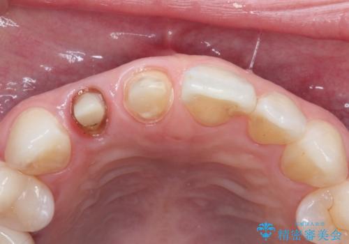 前歯が痛い。根管治療~オールセラミッククラウンの治療中