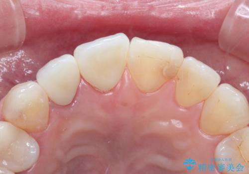 前歯が痛い。根管治療~オールセラミッククラウンの治療後